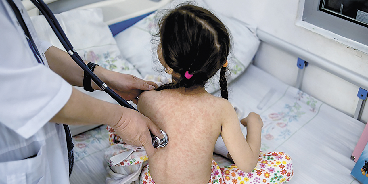 Una niña con síntomas del sarampión.