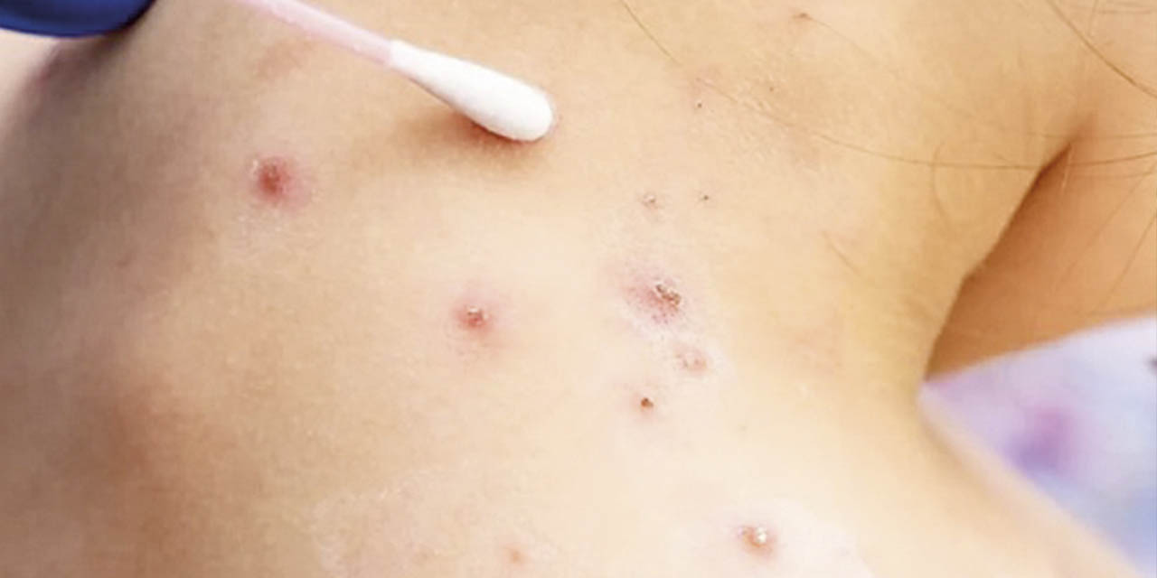 Síntomas de la enfermedad conocida como la viruela del mono o símica. | Foto: RRSS